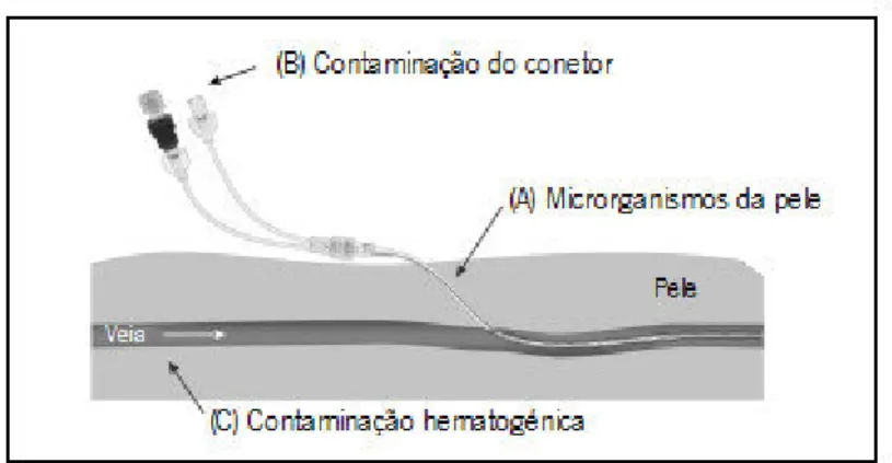 Figura 2: Potenciais vias de entrada dos microrganismos no cateter de HD 