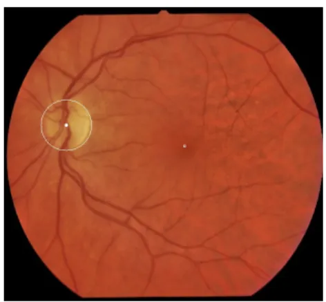 Figure 2.6. The area defined for the fovea search (left) and the final state, with the optic disc and the fovea successfully detected(right)