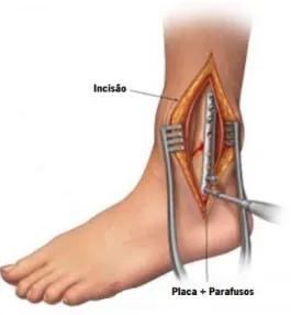 Figura 2.19 - Tratamento cirúrgico a uma fratura instável do tornozelo [5]. 