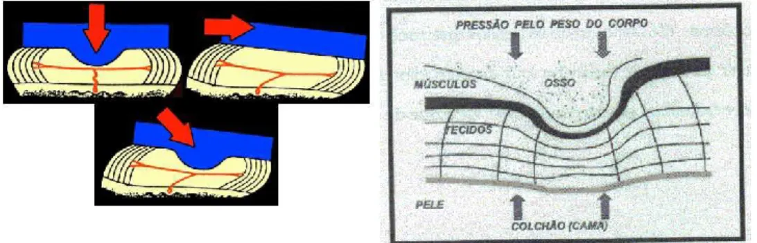 Figura 2.1 - Pressão e esforços no corpo humano (Cuidando, 2013) (Ribeiro A. R., 2008) 