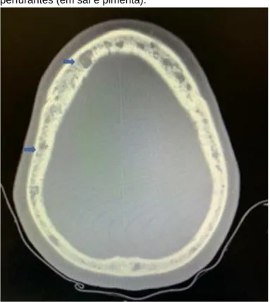 Figura  3  –  TC  de  crânio  com  lesões  osteoíticas  perfurantes (em sal e pimenta)