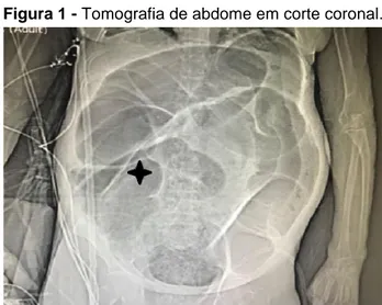 Figura 1 - Tomografia de abdome em corte coronal. 