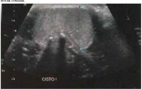 Figura  1  -  Ultrassonografia  de  região  cervical  evidenciando  cisto em  linha média