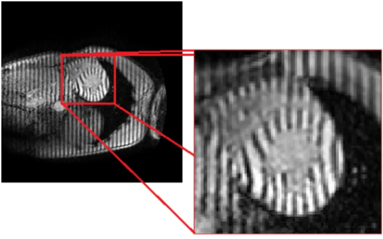 Figure 3.1: Original Thoracic Tagged MR image from anonymous patient (on the left) and analyzed section of the heart (on the right).