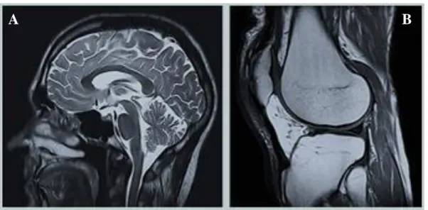 Figura 3 – Imagens do corpo humano obtidas por RM: A) RM do cérebro; B) RM do  joelho