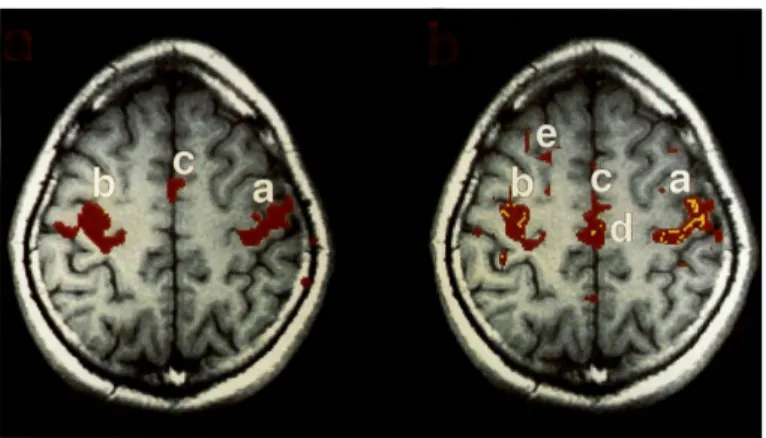 Figura 3-1 Primeiro mapa de conectividade funcional que permite observar a correlação entre  diferentes zonas motoras; adaptado de (Biswal, Yetkin, Haughton, &amp; Hyde, 1995)