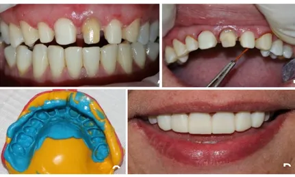 Figura  4  -  Dentes  com  desgastes  seletivos  (A).  Moldagem  por  meio  de  técnica  de  dupla  impressão