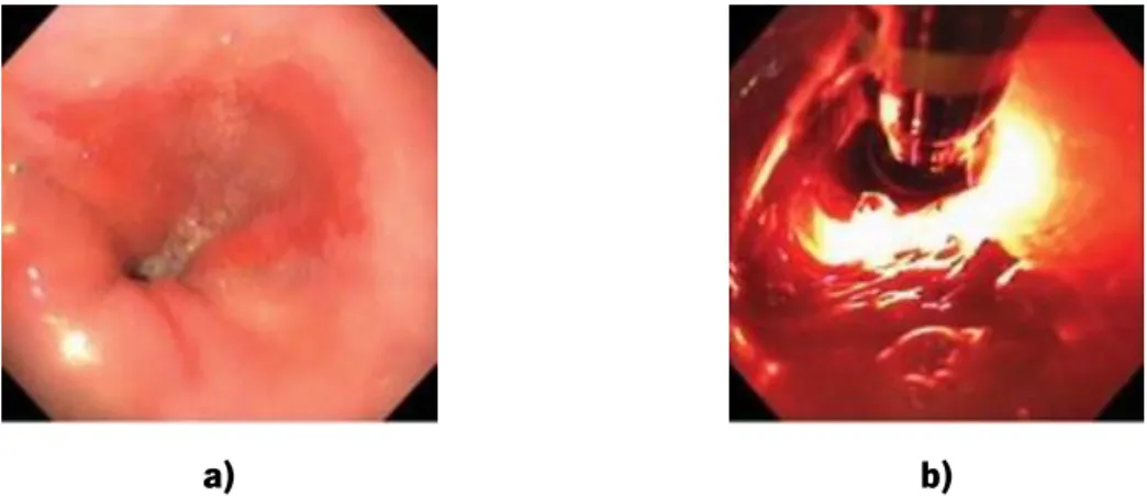 Figura 1.15 a) Esófago de  Barrett’s ; b) Aplicação de luz LASER na mucosa do esófago de  Barrett’s  com um endoscópio [42]