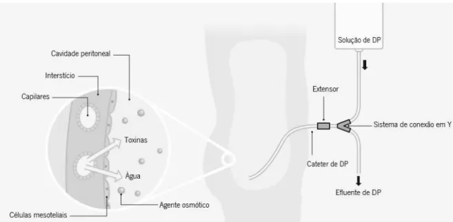 Figura 1 – Representação esquemática do sistema de DPCA: o extensor é conectado ao sistema em Y, permitindo a introdução da  solução de DP na cavidade peritoneal através do cateter de DP
