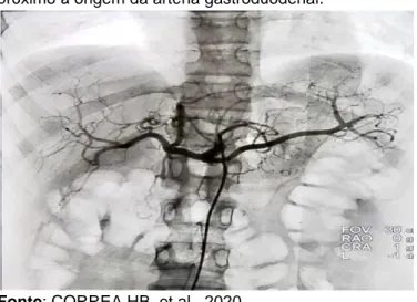 Figura 1 - Arteriografia via punção retrógrada de artéria  femoral comum direita demonstrando pseudoaneurisma  próximo à origem da artéria gastroduodenal