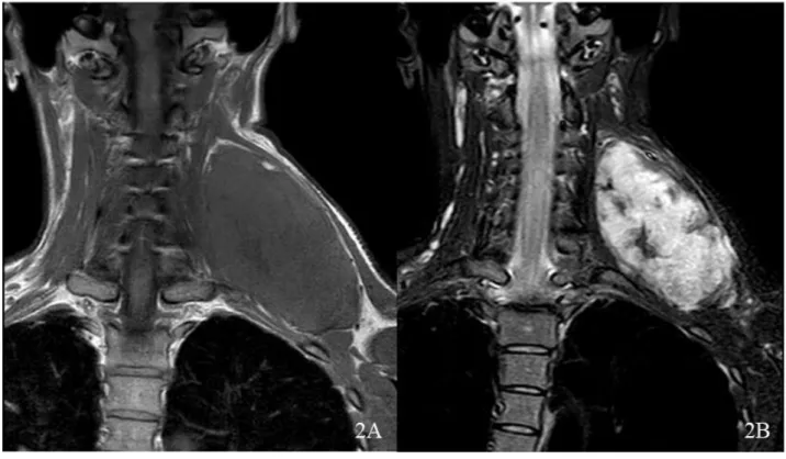 Figure 2 - Magnetic resonance imaging showing a left large neck mass T1 weighted, muscle isointense (A)