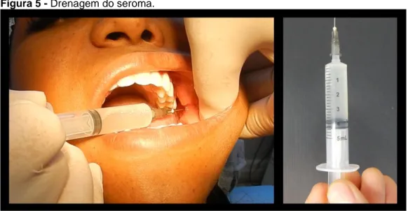 Figura 5 - Drenagem do seroma. 