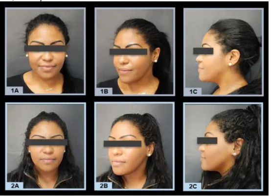 Figura 6 - Imagens 1A, 1B e 1C fotos iniciais. Imagens 2A, 2B e 2C fotos após 94  dias, finalização do caso