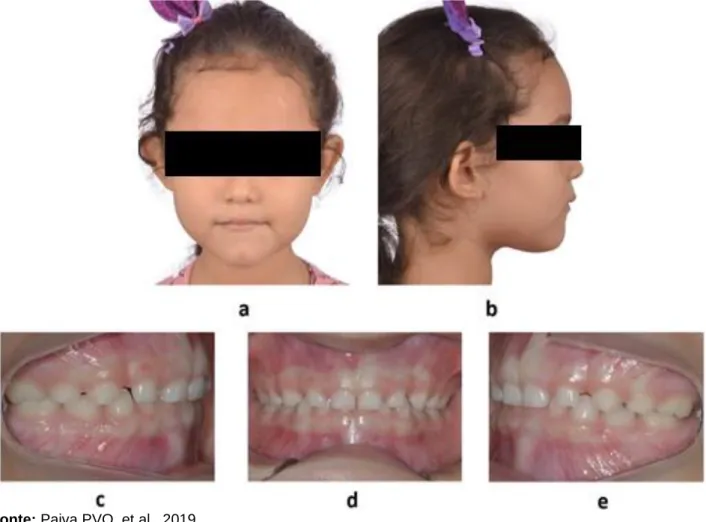 Figura 1 - 1a. Foto frontal da face; 1b. foto lateral da face; 1c. Foto intrabucal lateral direita, 1d