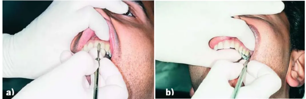 Figura 2 - Utilização do sindesmótomo reto num dente incisivo superior a) e do sindesmótomo curvo num dente  molar superior b) [4]