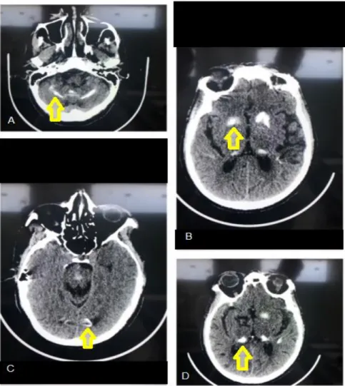 Figura  1  -  Tomografia  de  crânio  evidenciando  calcificações  simétricas  em cerebelo, tálamo e parênquima cerebral