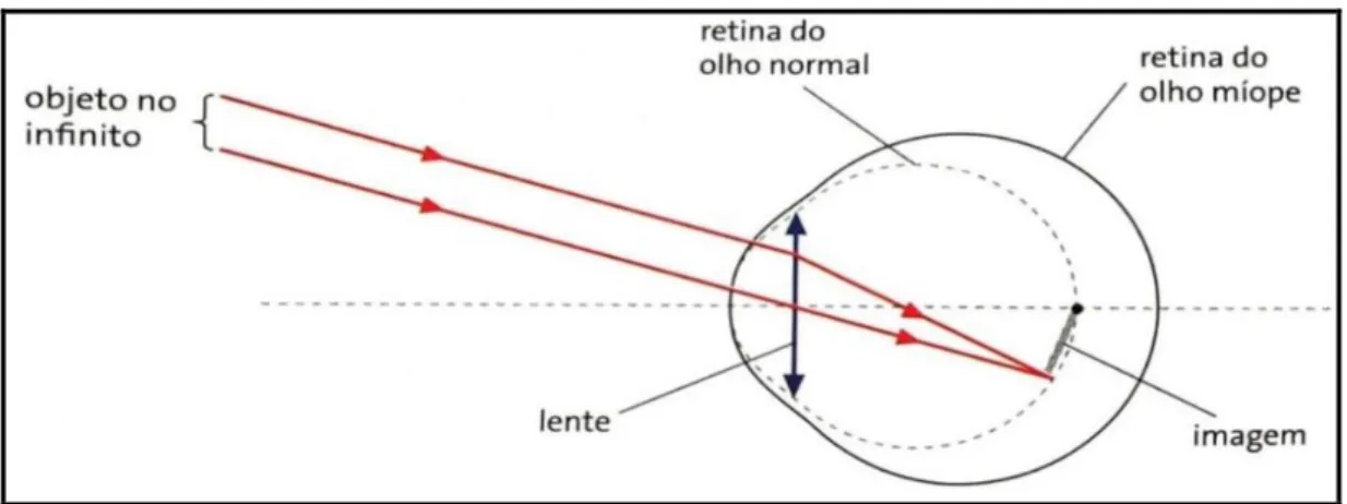 Figura 2. Olho míope. 