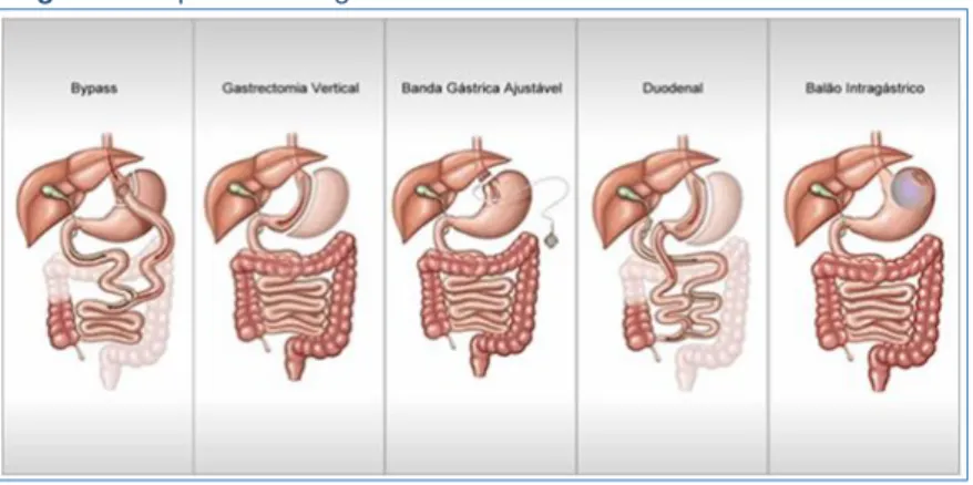 Figura 1 - Tipos de cirurgias bariátricas 