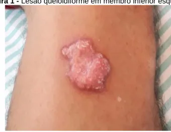 Figura 1 - Lesão queloidiforme em membro inferior esquerdo. 