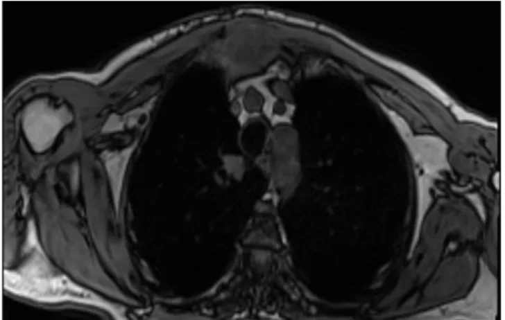 Figura  5  -  Radiografia  evidenciando  presença  de  fratura patológica em região de  metástase  óssea  em  fêmur  esquerdo