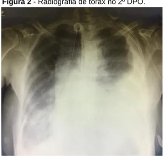 Figura 2 - Radiografia de tórax no 2º DPO. 