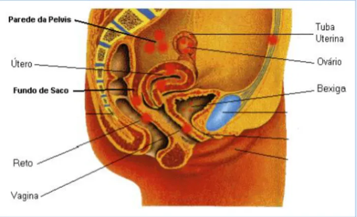 Figura 1 - Locais de implante do endometrioma. 