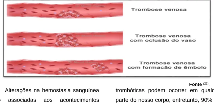 Figura 2 - imagem ilustrativa dos diferentes tipos de coagulos sanguíneos presentes na trombose.