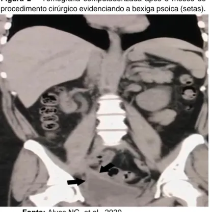 Figura  2  –  Tomografia  computadorizada  após  3  meses  do  procedimento cirúrgico evidenciando a bexiga psoica (setas)