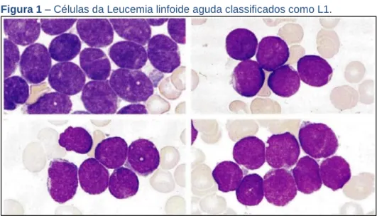 Figura 1 – Células da Leucemia linfoide aguda classificados como L1. 