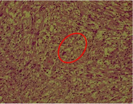 Figura 4 - Detalhe mostrando células com núcleos redondos, sem  atipias  e  com  citoplasmas  claros  (Hematoxilina-Eosina,  aumento  original de 20x)