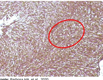 Figura  5  -  Tumor  Glúteo  direito,  coloração  demonstrando  expressão para proteína S-100 