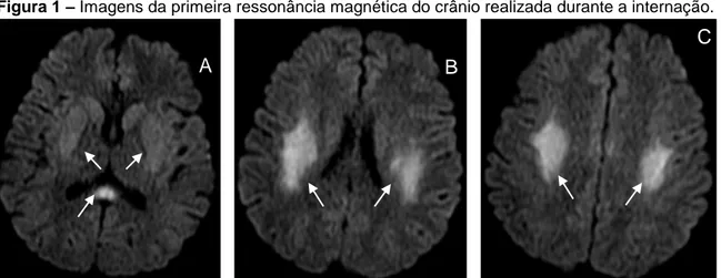 Figura 1 – Imagens da primeira ressonância magnética do crânio realizada durante a internação