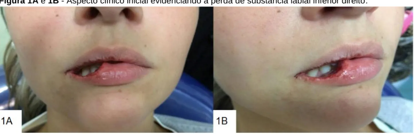 Figura 1A e 1B - Aspecto clínico inicial evidenciando a perda de substância labial inferior direito
