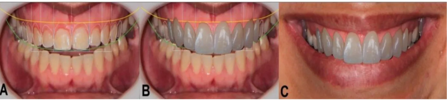 Figura 2  – Planejamento DSD: desenho das linhas de referências estéticas e contorno dos dentes guiado  pela proporção do retângulo (A) e visão virtual da proporção ideal dos dentes (B e C)