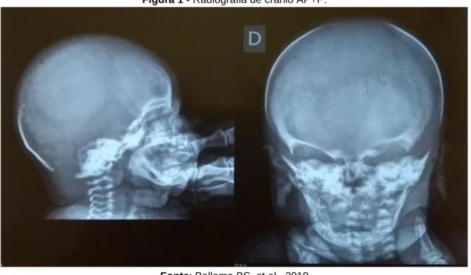 Figura 1 - Radiografia de crânio AP+P.