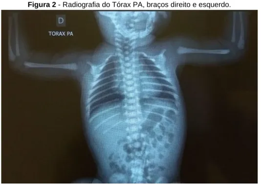 Figura 2 - Radiografia do Tórax PA, braços direito e esquerdo.