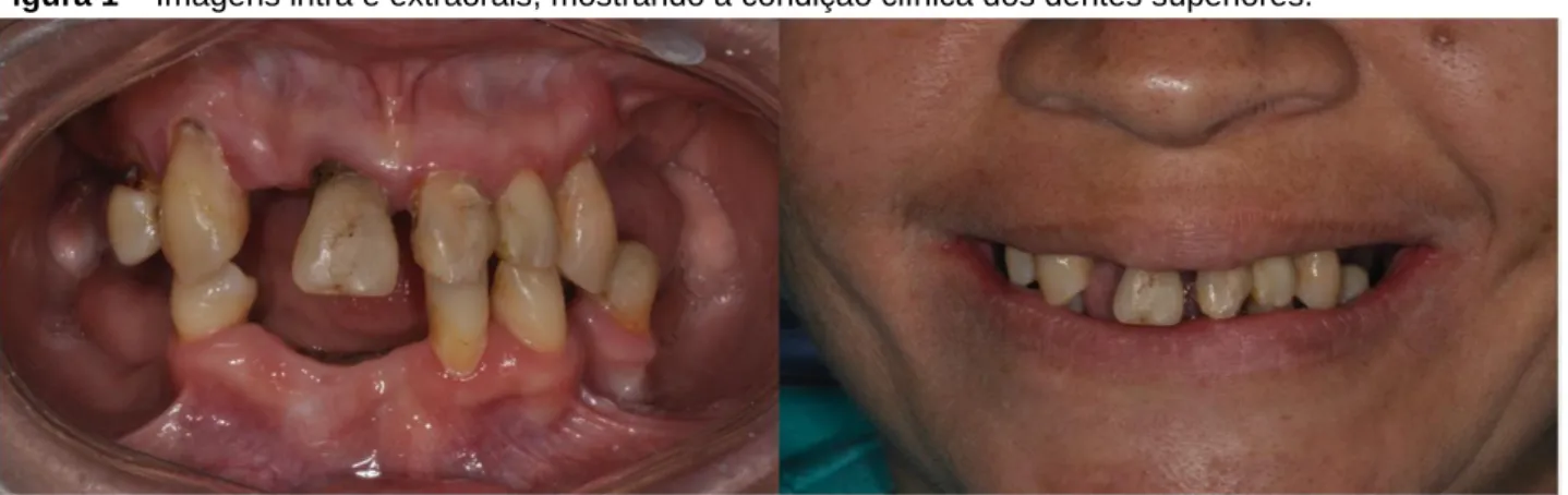 Figura 1 – Imagens intra e extraorais, mostrando a condição clínica dos dentes superiores