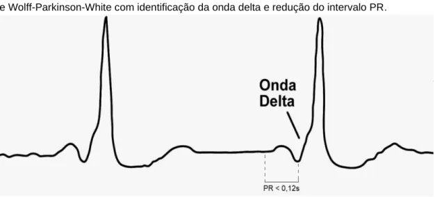 Figura 2 - Representação gráfica de um eletrocardiograma de um paciente portador da síndrome  de Wolff-Parkinson-White com identificação da onda delta e redução do intervalo PR