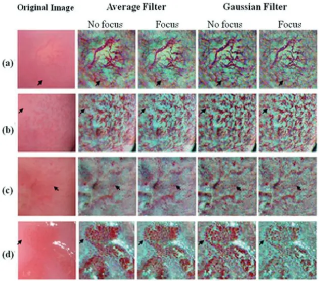 Figure 8. Sections of colposcopic images for vascular patterns: hairpin (a), cloth (b) and dotted (c, d)