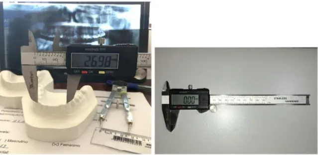 Figura 1 - Paquímetro Digital MTX ®  0,01-150 mm/0,0005&#34; para medição da distância intercaninos