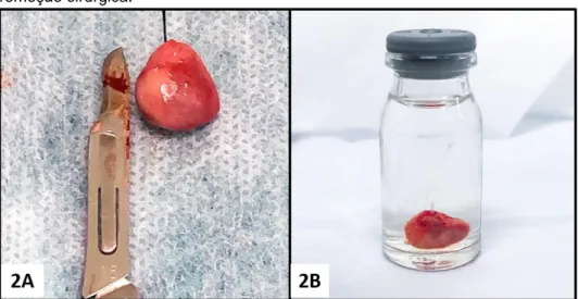 Figura  2  -  Fotografias  da  lesão  de  hiperplasia  fibrosa  inflamatória  após  remoção cirúrgica