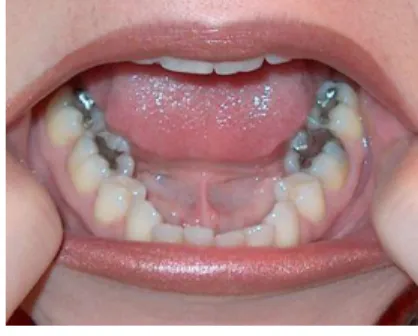 Figura 6 – Imagem de resina para restaurações dentais utilizada na dinâmica ‘Que  dilatação sou eu?’, simbolizando a dilatação volumétrica