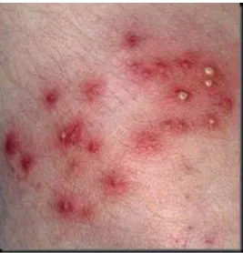 Figura 7. Infecção na pele provocada por bactérias do género  Pseudomonas  [32]