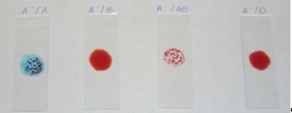 Figura 1.2b Teste em lâmina aplicado a uma amostra sanguínea tipo A negativa, a reagir com Anti-A (A - /A), Anti-B  (A - /B), Anti-AB (A - /AB) e Anti-D (A- /D)