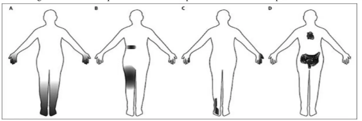 Figura 1- Desenho esquemático - diferentes padrões clínicos da neuropatia diabética. 