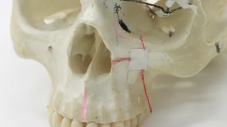 Figura 4 Ramo maxilar n. infraorbital, n. palpebral inferior, n. nasal e n. labial superior