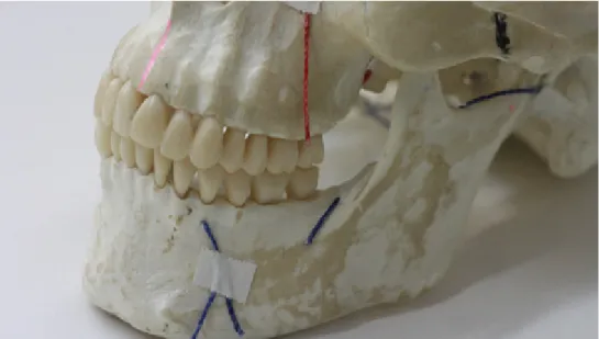 Figura 5 Vista anterior da mandíbula onde se podem observar os ramos nervosos mentual, aurículo  temporal e bucal.