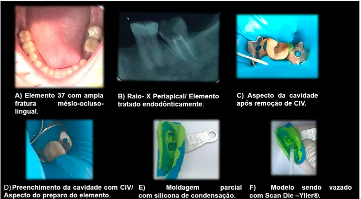 Figura 01. A) Elemento 37 com ampla fratura mésio-ocluso-lingual. B) Raio- X Periapical/ Elemento tratado  endodônticamente