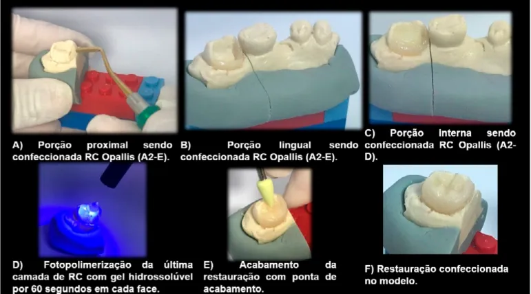 Figura 03. A) Porção lingual sendo confeccionada RC Opallis (A2-E). B) Porção interna sendo confeccionada  RC Opallis (A2-D)