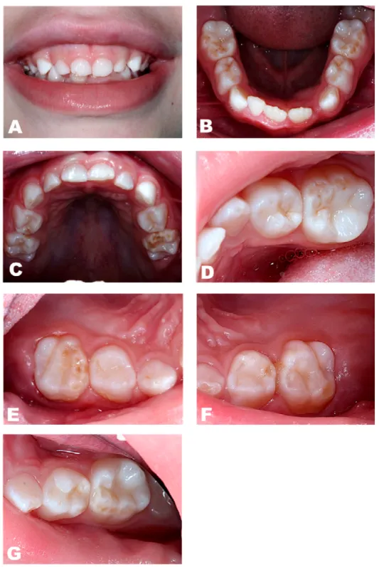 Figura 1. Exame clínico: A) Sorriso extra oral; B) Arco dentário inferior; C) Arco dentário superior; D)  Molares decíduos inferiores direitos; E) Molares decíduos superiores esquerdos; F) Molares decíduos 